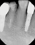 Radiograph of the bonded post and sleeve and core buildup.