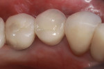 Occlusal view of the seated final crown.