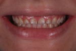 Preoperative smile view showing small teeth with severe wear in the upper anterior
region.