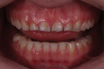 Preoperative retracted view with teeth apart showing moderate erosion on the lower anterior teeth. Note that the tissue levels of teeth Nos. 8 and 9 show some degree of
compensatory overeruption.