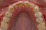 Preoperative maxillary occlusal view demonstrating severe erosion on the patient’s upper anterior teeth with additional erosion on her upper left posterior teeth.