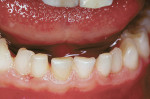 Figure 1  Two double primary incisors seen in 5-year-old male patient.