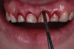 Closed crestal contouring was carried out with a Wedelstaedt chisel to the levels determined by the digital smile design. Before carrying out this procedure, it is mandatory to sound for the cementoenamel junction to avoid exposing any root surface. Please note that this kind of flapless crown
lengthening should only be performed on patients with thin or normal gingival biotypes and a on limited number of teeth.