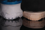 The wax-up of the upper arch was duplicated, then every second tooth was removed from the duplicate. The same procedure was carried out on the wax-up of the lower arch.