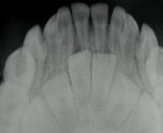 Figure 2  Mandibular occlusal radiograph of double primary incisors.