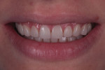 Postoperative smile view exhibiting harmonious tooth proportions.