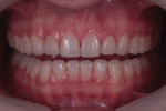 Postoperative retracted facial view with teeth apart demonstrating soft-tissue health. One of the advantages of choosing composite is that it does not require a waiting period of 3 months after crown lengthening because any possible biologic width violation can be easily remedied, and the soft tissue generally reacts favorably to a well-polished composite surface.
