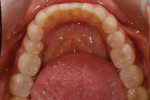 Postoperative mandibular occlusal view of the lower arch. Note that the existing crown on tooth No. 30 has been replaced.