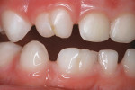 Figure 3  Maxillary and mandibular double teeth in 4-year, 9-month-old male patient.