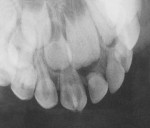 Figure 4  Maxillary double primary incisor.