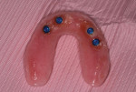 The final horseshoe shaped overdenture demonstrated excellent retention and stability.