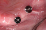 View of the surgically placed maxillary implants with healing abutments in place.