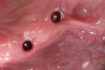 View of the implants with the healing abutments removed demonstrating the healthy tissue cuff that was created.