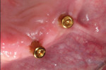 The attachment abutments were threaded into place and torqued to 30 Ncm. Note that they rest approximately 1.5 mm above the crest of the soft tissue.