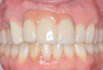 Fig. 1. Preoperative condition. Pink ceramics had been used to compensate for hard- and soft-tissue deficiencies in the esthetic zone.