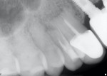 Fig. 2. Preoperative radiographs depicting failing natural teeth Nos. 5 and 6 due to apical root resorption and hypermobility.