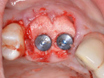 Fig. 6. After impression-taking, a dermal allograft was trimmed and adapted over the healing abutments and bone graft.