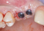 Fig 7. Transmucosal healing was selected, and the patient was immediately temporized by the restorative dentist via the impression obtained prior to closure.