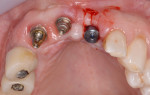 Fig. 9. Ten weeks after surgery, a minor incision was utilized to remove the cover screw from and attach a healing abutment to the No. 9 implant.