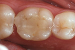Figure 2  Preoperative clinical condition of tooth No. 19 with fractured distal marginal ridge.