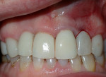 Fig. 8. Screw-retained laboratory-milled PMMA crown on abutment, delivered on the same day of the extraction and immediate implant placement. Note flapless approach.