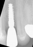 Fig. 14. Final screw-retained crown No. 10 at 4 months post-placement.