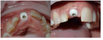 Fig. 15 and Fig. 16. Custom healing abutment at the time of extraction and immediate implant placement No. 9.