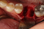 Fig. 1. After extraction of the failing first molar, insufficient bone was present, disallowing immediate implant placement and necessitating a delayed approach with socket grafting before implant placement into a healed site.