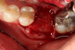Fig. 3. A collagen membrane was placed over the mineralized cancellous allograft and tucked under the buccal and lingual flaps.