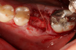 Fig. 4. The site was closed with 5-0 PGA suture to contain the resorbable membrane and fixate the previously elevated flap margins.