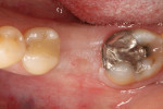 Fig 5. The healed grafted socket after 5 months demonstrated coverage with healthy non-inflamed keratinized gingival tissue.