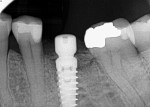 Fig. 9. Radiograph taken immediately after implant placement demonstrated blending of the graft material with host bone.