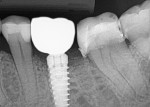 Fig. 10. Radiograph of the osseointegrated implant following a 3-month integration period and placement of the restoration to verify mating of the abutment with implant; stability of the graft crestally was noted.