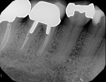 Fig. 12. Radiograph of mandibular right first molar, which presented with a furcation issue and suspected fracture at the furcation.