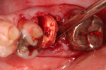 Fig. 13. The tooth being extracted was sectioned at the furcation, and the distal root was elevated after removal of the mesial root.