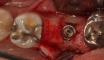 Fig. 18. A 4.1 mm x 10 mm bone-level implant was placed into the osteotomy created at the center of the previously grafted socket.