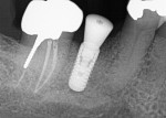 Fig. 19. Radiograph taken immediately following implant placement into the previously grafted extraction socket with a healing abutment placed.