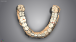 Fig. 3. Provisional mandibular complete-arch wax-up.