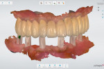 Fig. 14. Maxillary and mandibular scan mounted digitally in correct OVD.