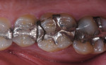 Fig. 1. Preoperative view of fractured amalgam on first molar.