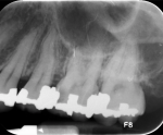 Fig. 2. Periapical X-ray showing deep caries.