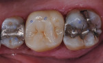 Fig. 9. Occlusal adjustment and final polishing completed.