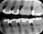 Fig. 10. Two-year follow-up bitewing x-ray confirmed ideal adaptation and caries-free margins.