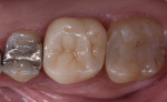 Fig. 11. Occlusal view of the restoration at 2-year follow-up. It should be noted that the patient had recently completed orthodontic treatment and was using retainers to re-establish interproximal contacts.