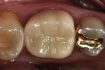 Figure 10  IPS e.max CAD crown No. 19 at 2-year recall evaluation (Figure 10), and at 4-year recall evaluation (Figure 11).