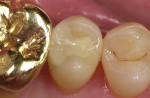 Figure 12  Evaluation of Paradigm MZ100 inlay on tooth No. 13 at 2-year recall (Figure 12), 6-year recall (Figure 13), and 10-year recall (Figure 14).