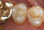 Figure 14  Evaluation of Paradigm MZ100 inlay on tooth No. 13 at 2-year recall (Figure 12), 6-year recall (Figure 13), and 10-year recall (Figure 14).