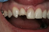 Figure 7  FINAL RESULTS Completing dental treatment gave Joe a newfound sense of self-esteem.