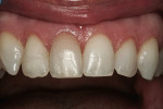 Figure 2  The fractured incisal fragment from the maxillary right lateral incisor was bonded into position with flowable.composite.