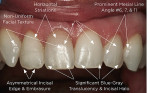 Figure 4  An example of color/contour mapping of fractured tooth No. 7 and the adjacent dentition to be used during treatment planning for a same-day, custom-characterized, ceramic restoration